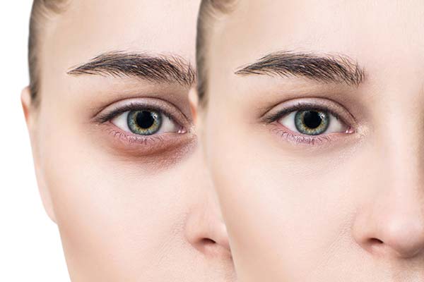 How to remove dark circles under the eyes - North Street Dental