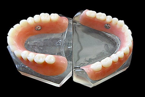 Suction dentures - North Street Dental